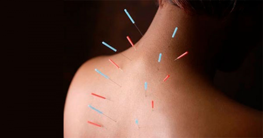 La acupuntura puede aliviar el dolor de cuello